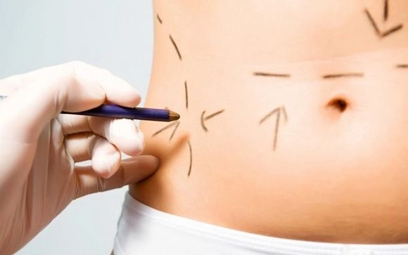 Diez respuestas sobre la liposucción