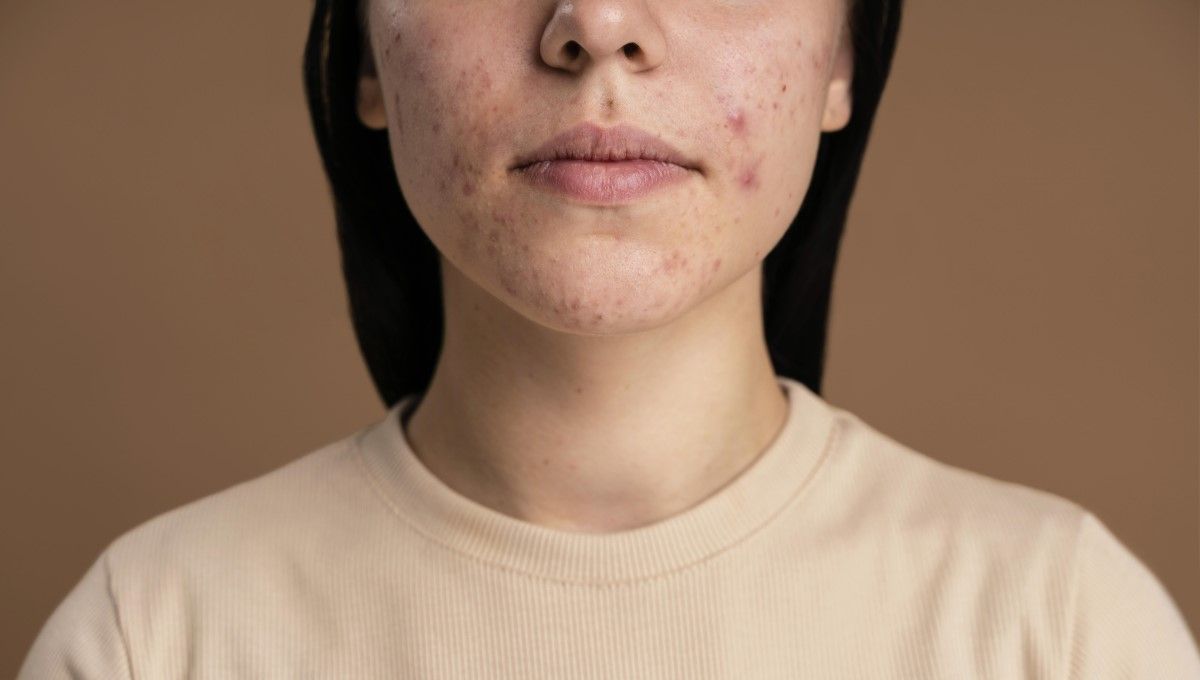 Mujer con acné en en el rostro (Foto. Freepik)
