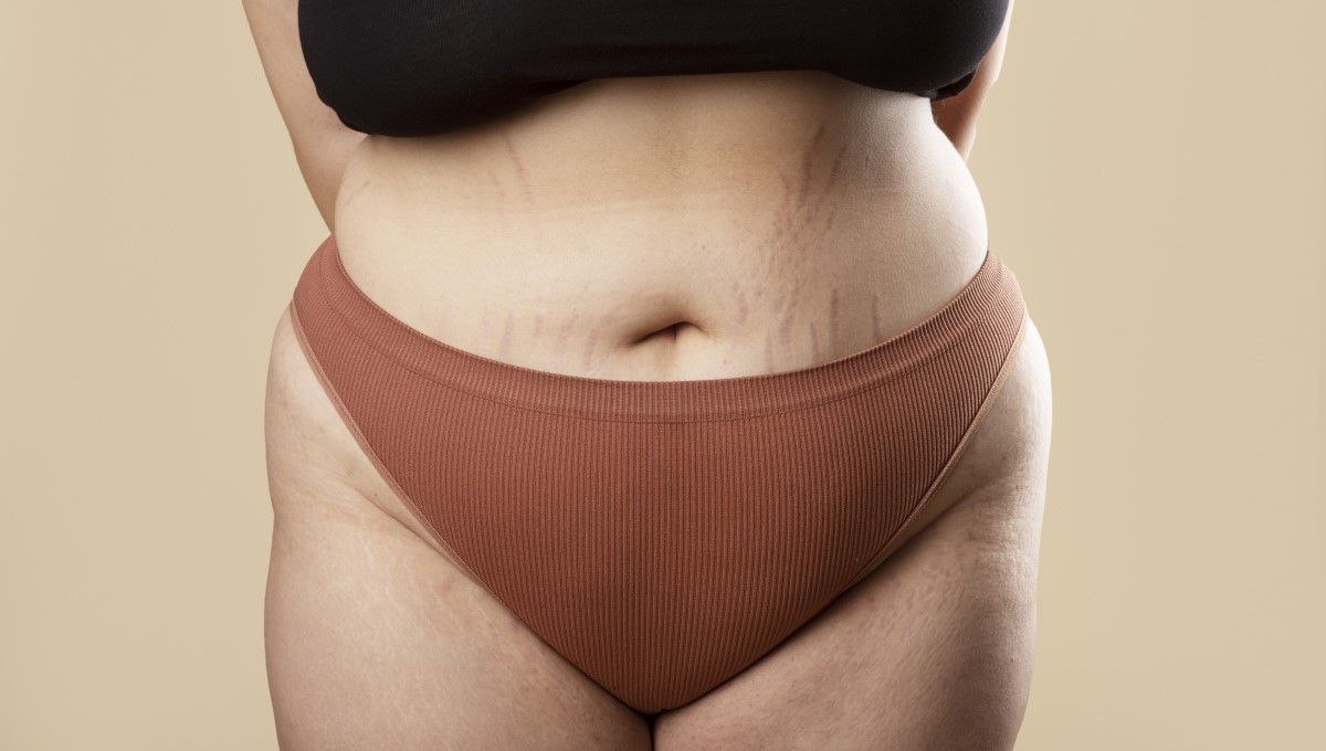 Mujer con estrías en el abdomen (Foto. Freepik)