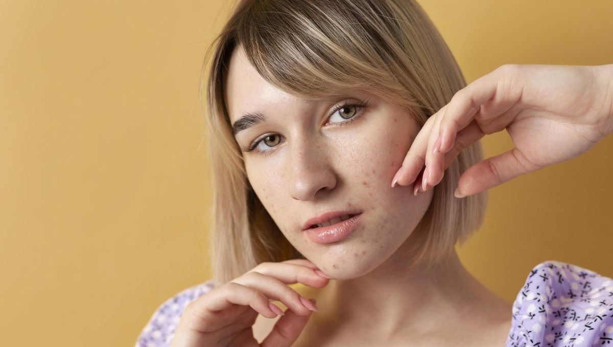 Mujer joven con acné en el rostro en verano (Foto. Freepik)