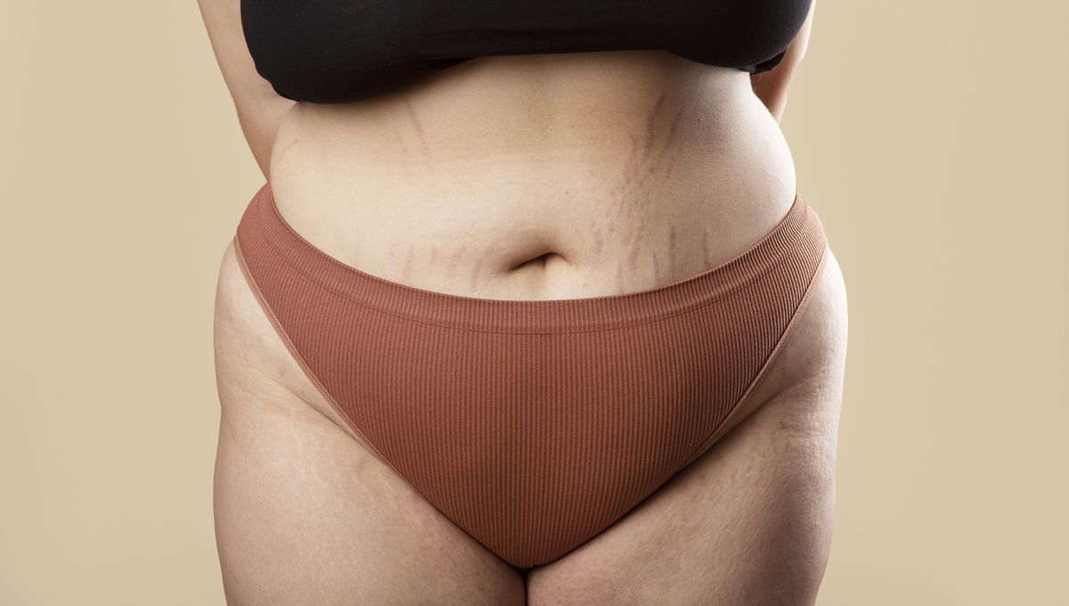 El lipedema debe abordarse desde un enfoque integral y holístico (Foto. Freepik)