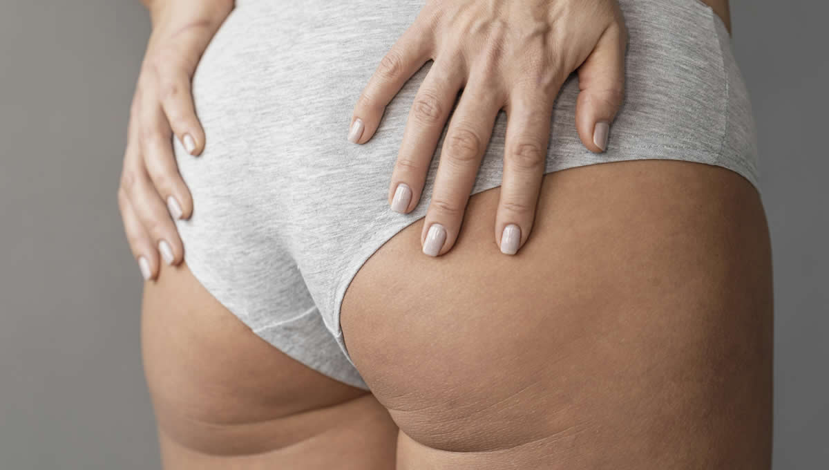 La apariencia de la celulitis puede mejorarse con ejercicio y tratamientos (Foto. Freepik)