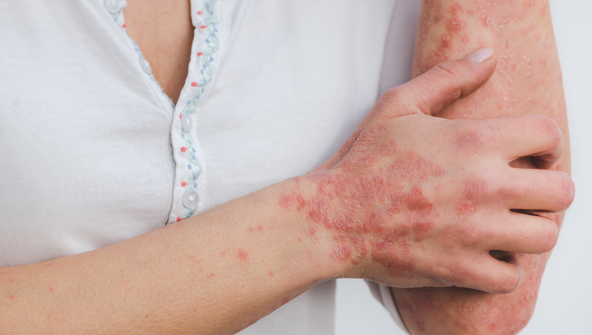 La psoriasis es una enfermedad de la piel que afecta en gran medida a la autoestima (Foto. Canva)