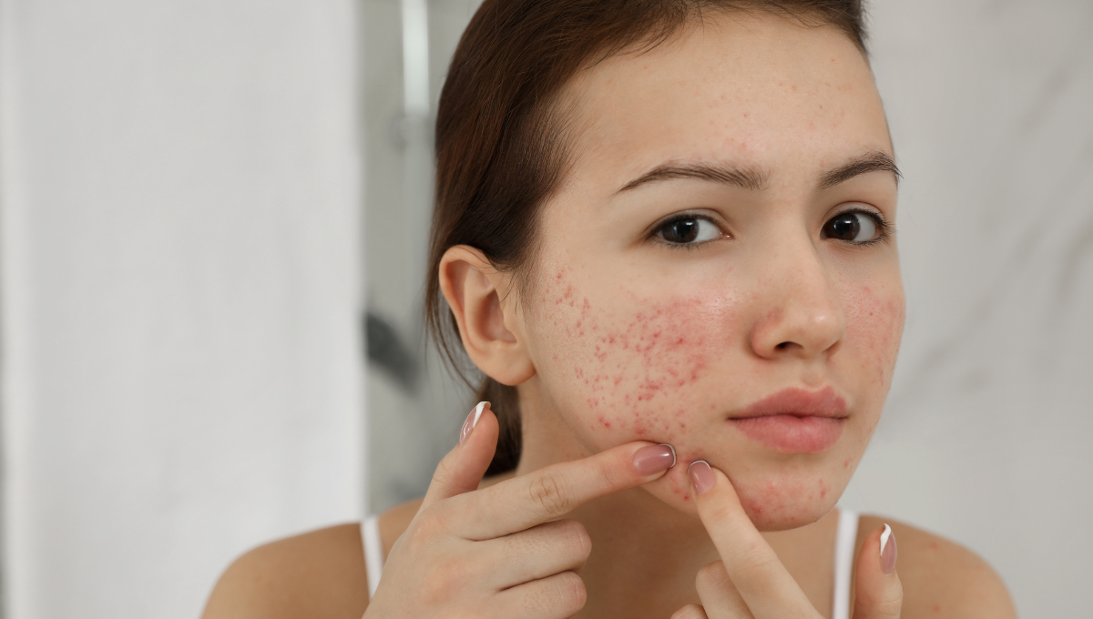 La dermatitis perioral, una inflamación cutánea recurrente (Foto. Canva)