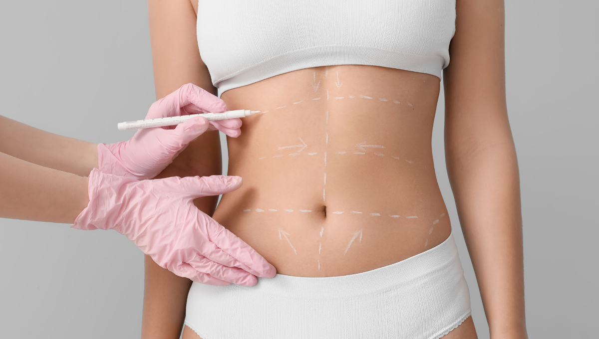 La abdominoplastia, una opción para quienes desean un cambio radical (Foto. Canva)