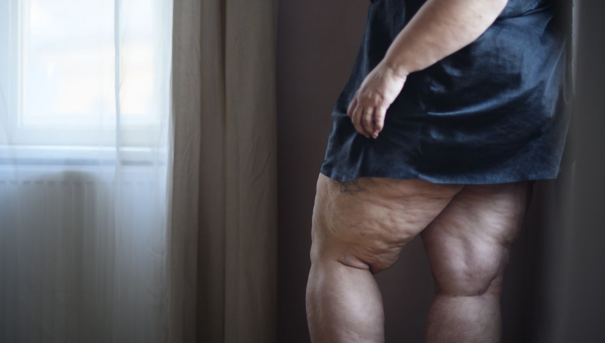 El lipedema, una enfermedad crónica dolorosa (Foto. Canva)