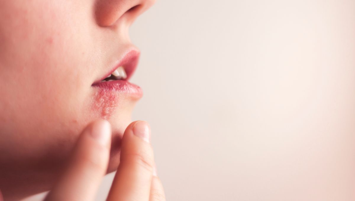 El herpes labial no se trata con cualquier crema (Foto. Canva)