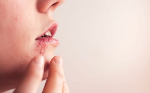 No trates el herpes labial con cualquier crema: desde el Instituto Natividad Cano te lo explican