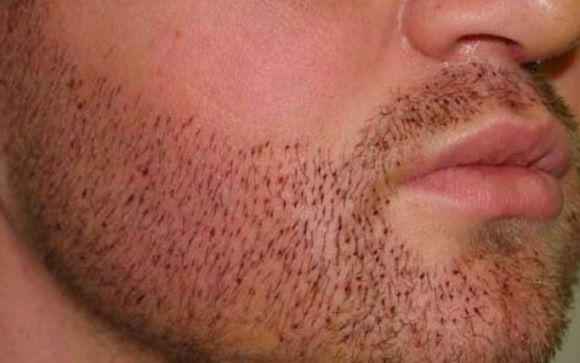 Implantes de barba un reclamo en auge