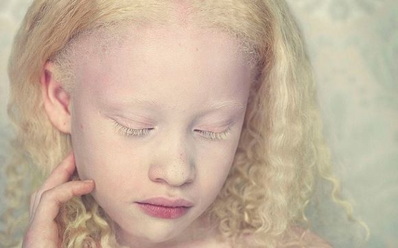 ¿Cómo debe protegerse la piel un albino?