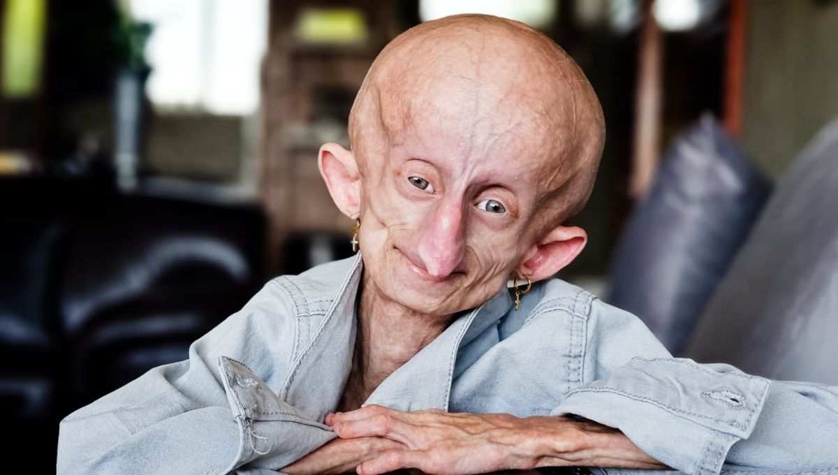 Beandri Booysen, la influencer que visibilizó la progeria (Foto. Facebook)