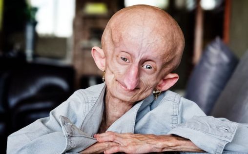 Muere Beandri Booysen, la influencer que visibilizó la progeria, a los 19 años