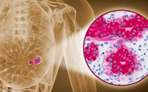 An image-guided breast biopsy is able to predict residual cancer