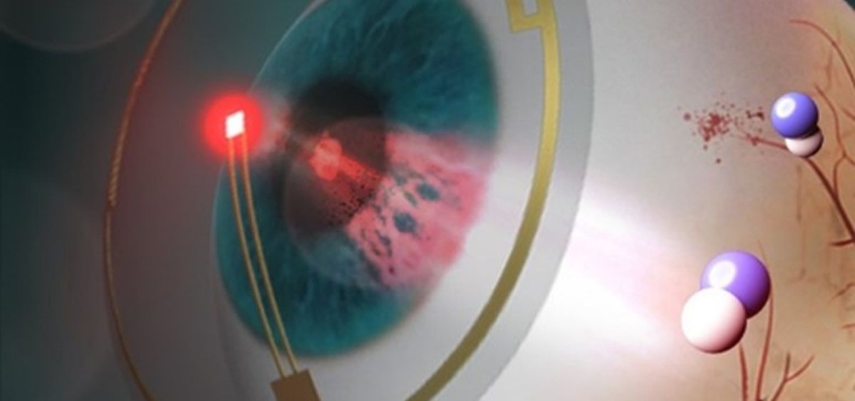 Unas lentes de contacto inteligentes previenen la retinopatía diabética. (Foto. Postec)