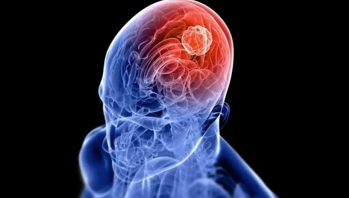 Nueva plataforma de investigación para evaluar mutaciones del cáncer cerebral durante la cirugía. (Clínica Mayo)