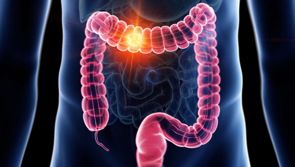 Las proteínas presentes en la carne, la leche y otros alimentos pueden suprimir tumores intestinales (Fuente Canva)