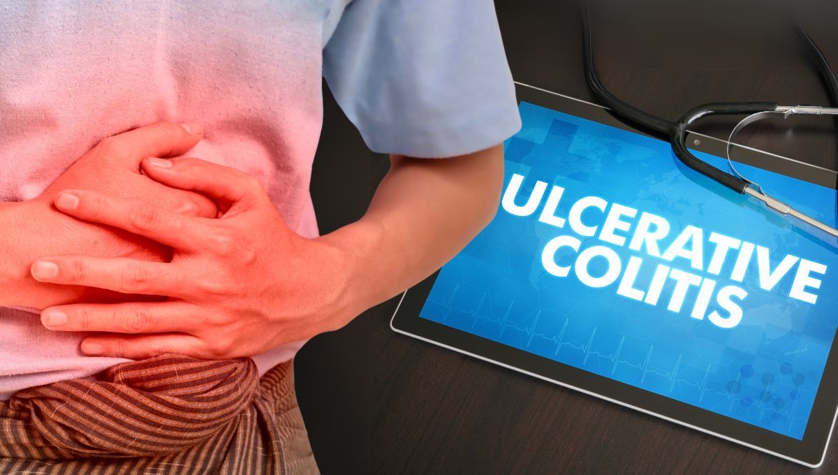 Un estudio identifica un gen que predice si un paciente sufrirá colitis ulcerosa grave (Montaje ConSalud)