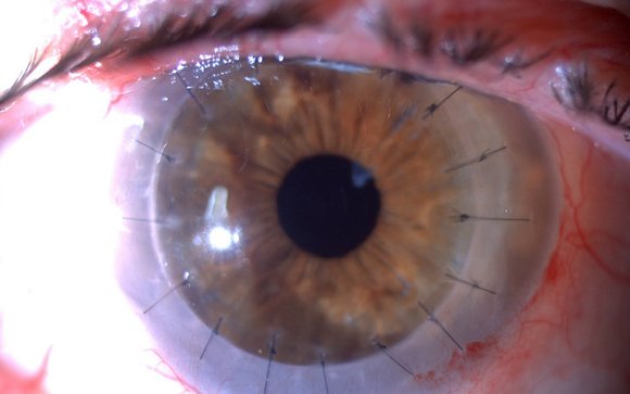 El cultivo de células endoteliales, opción a estudio para tratar las patologías del endotelio corneal