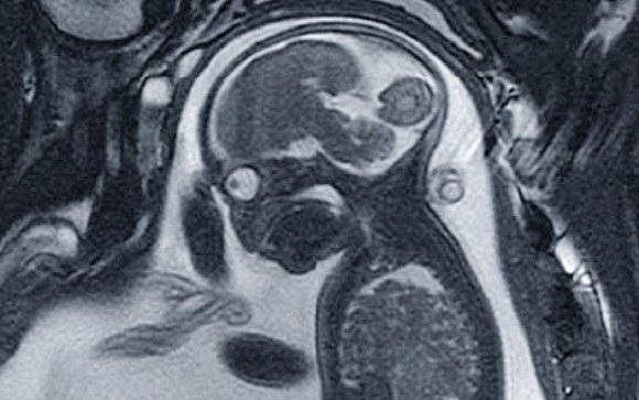 Resonancia magnética fetal: segura e inocua para el feto