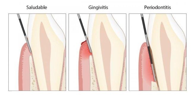 Diagnóstico de la periodontitis (Fuente: Periodontal Health)