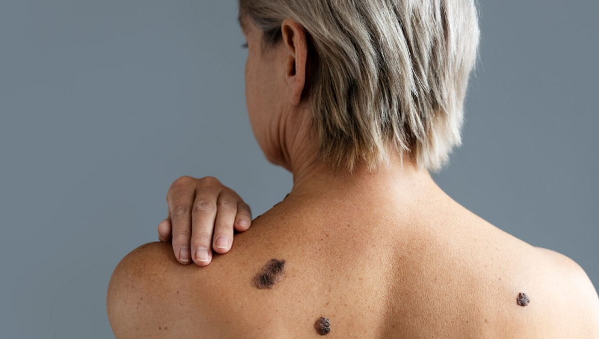 La incidencia del melanoma aumenta más de un 1% anualmente (Foto. Freepik)