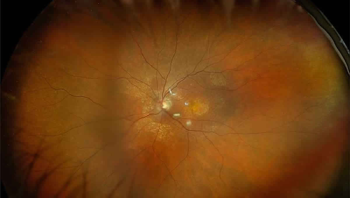Retina con degeneración macular asociada a la edad. (Foto: Miranza)