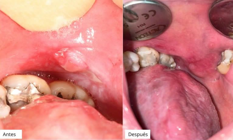 Evolución de un caso de reacción liquenoide tratado por el Dr. Jorge Guzman Russo (Fotos cedidas a ConSalud)