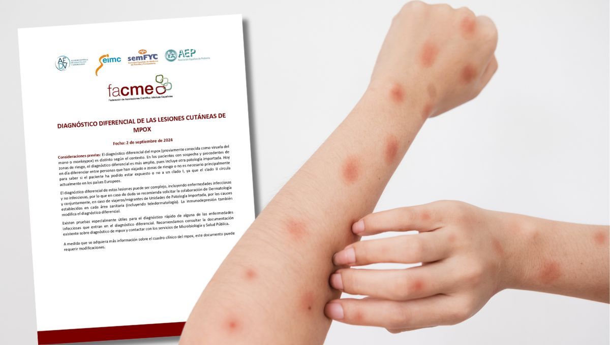 FACME ha actualizado el documento Diagnóstico diferencial de las lesiones cutáneas de mpox (Montaje Consalud)