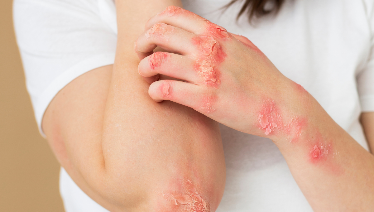 La AADA lanza los resultados de una campaña de sensibilización sobre dermatitis atópica (Foto. Freepik)