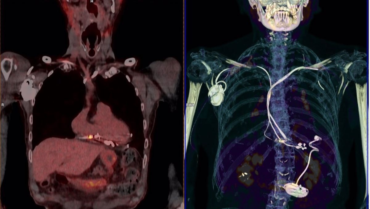 Image de archivo de un estudio PET TC (Foto. Sociedad Española de Medicina Nuclear e Imagen Molecular)