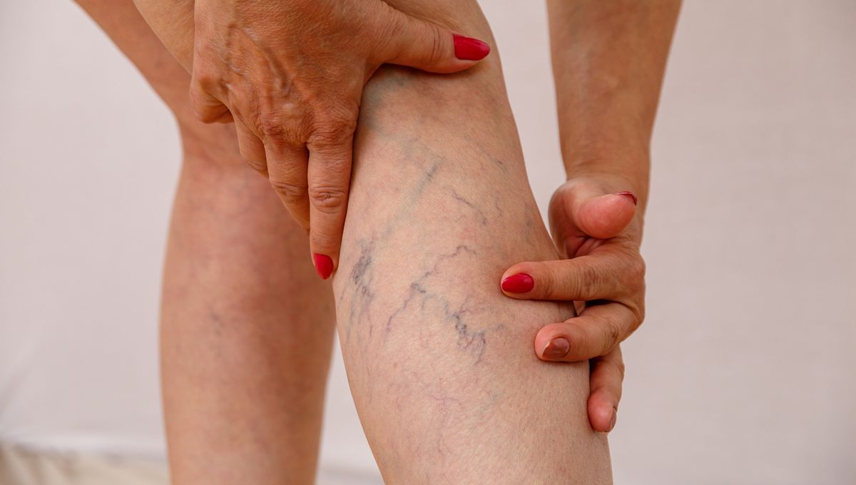 Mujer con varices (Foto. Quirónsalud)