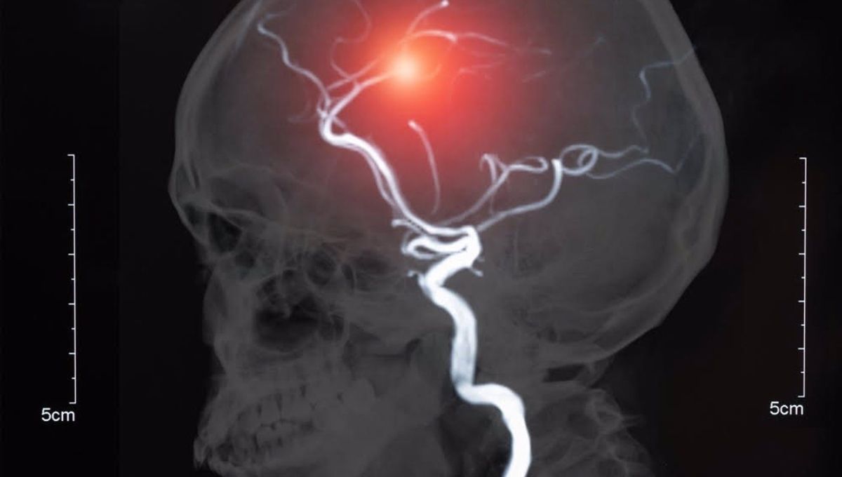 La recuperación de enfermos con ictus mejora con estimulación cerebral y rehabilitación robótica  (Foto. Europapress)