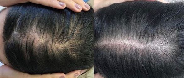 Notable Digno Polémico Nuevo tratamiento contra la alopecia femenina